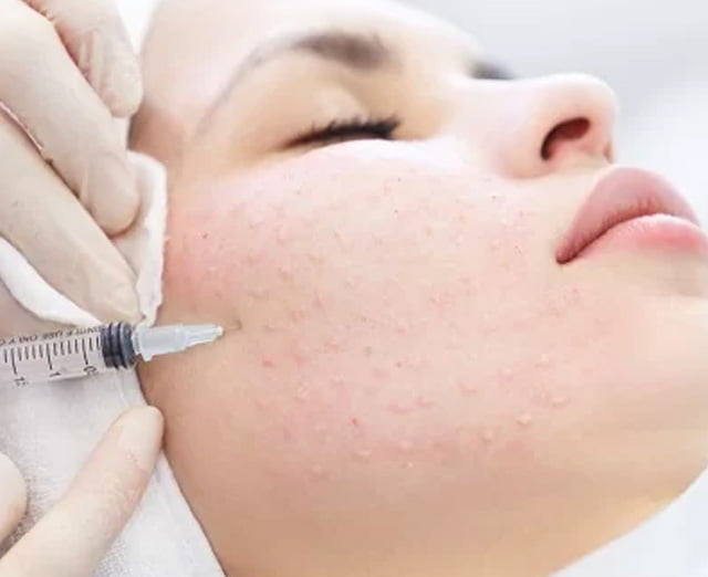 mesotherapy for Face 2